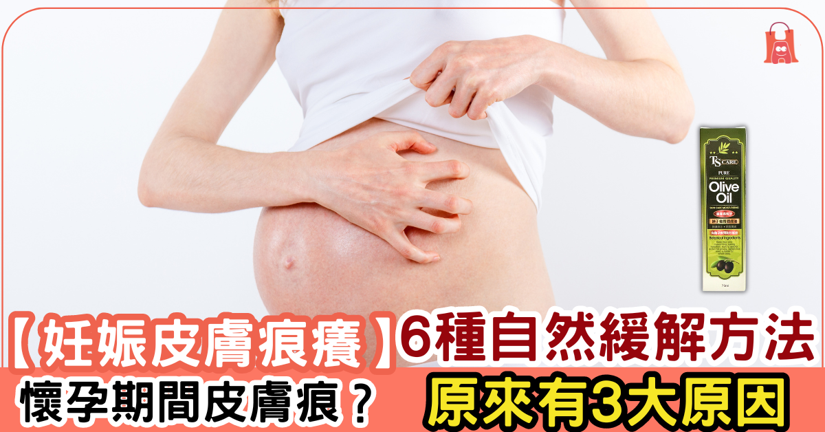 【妊娠皮膚痕癢】懷孕期間為什麼會皮膚痕?6 種自然緩解方法